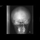 Fissure of the occipital bone: X-ray - Plain radiograph
